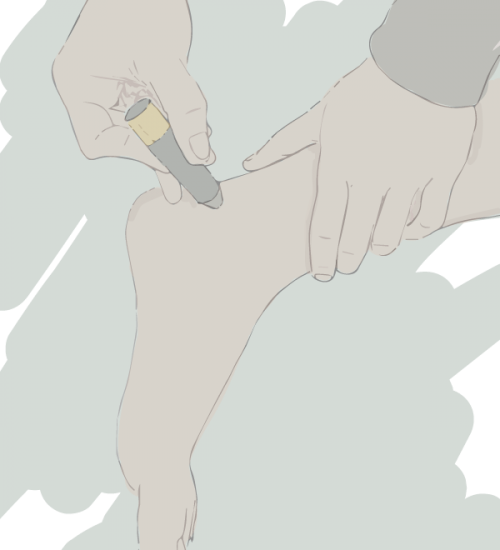 Illustration d'un moxa au niveau du pied